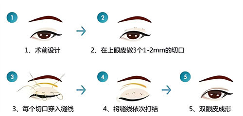 双眼皮三点术过程原理