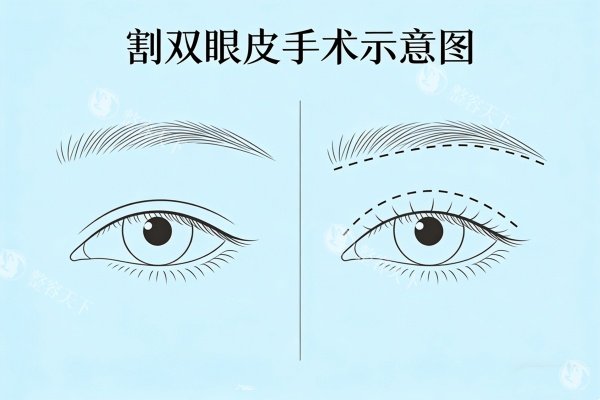 割双眼皮手术示意图