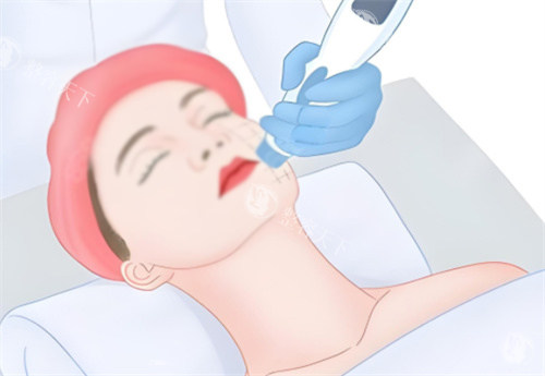 面部热玛吉