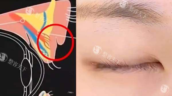 cfs悬吊术改善双眼皮修复